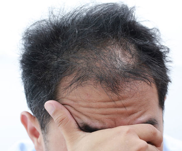 Male Pattern Hair Loss