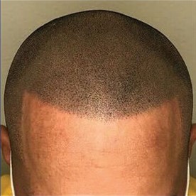 HAIR SYSTEMS