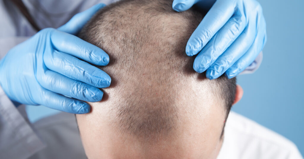 3000-grafts-hair-transplant-cost
