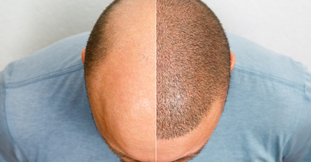 4000-grafts-hair-transplant-cost