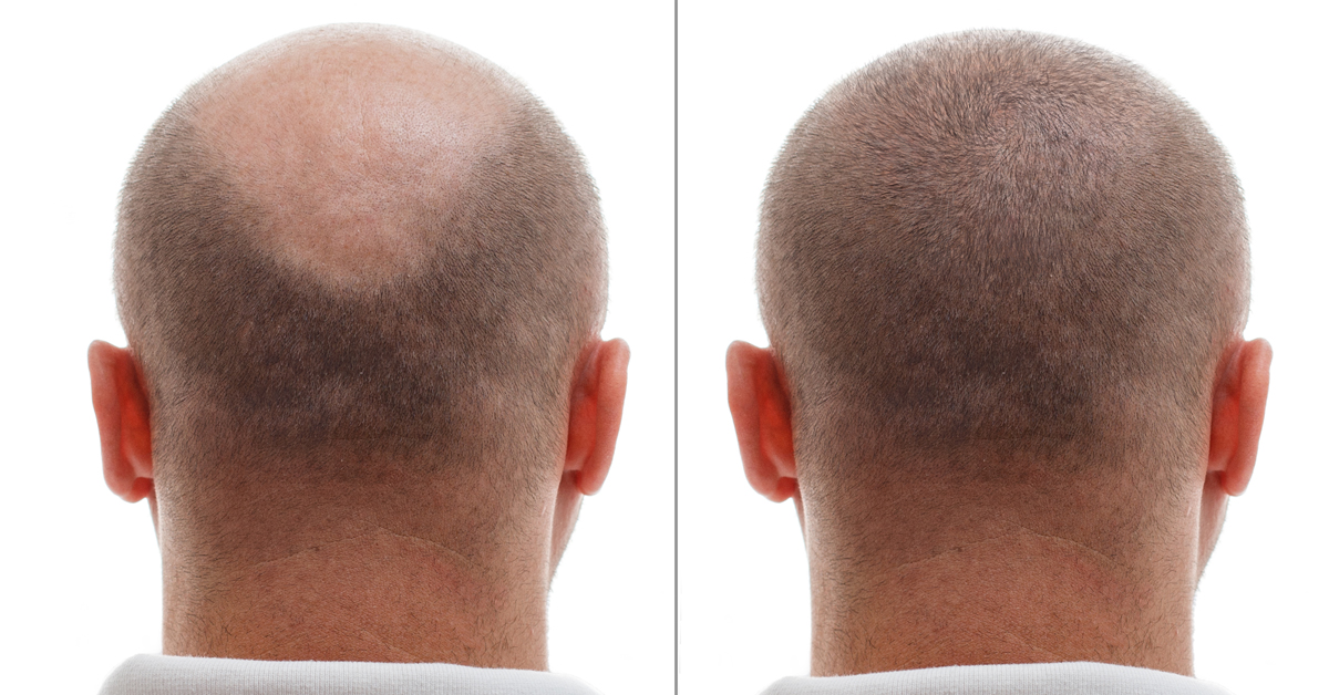 5000-grafts-hair-transplant-cost