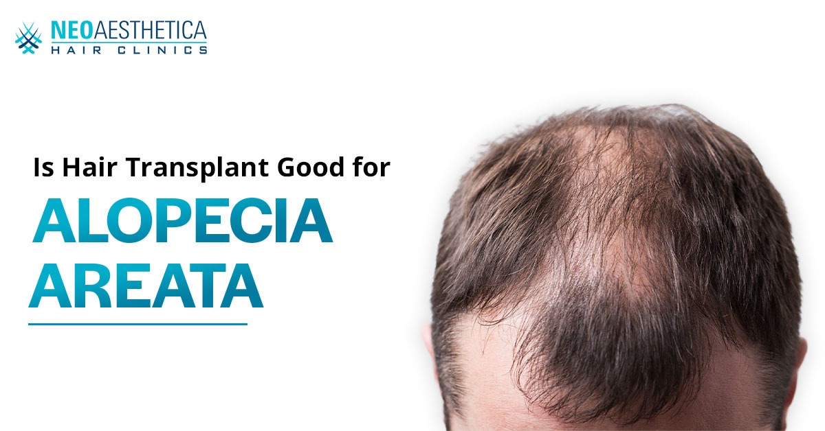 Hair-transplant-for-alopecia-areata
