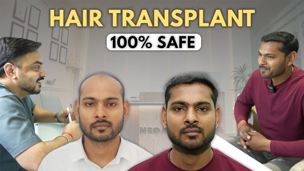 before-after-ashish-hair-transplant-look