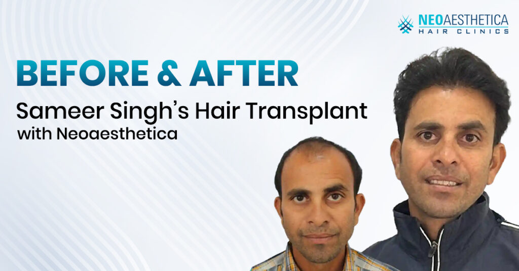 sameer-singh-hair-transplant-results